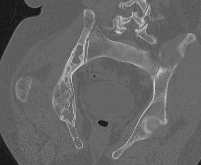 Fibrous Dysplasia CT